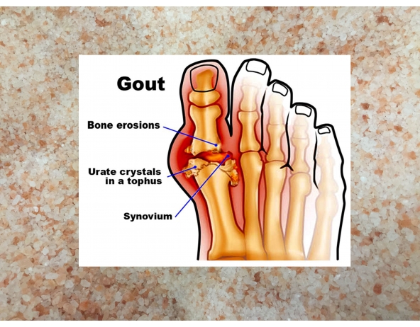 Himalayan Pink Salt for Arthritis and Gout